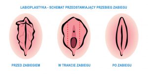 labioplastyka