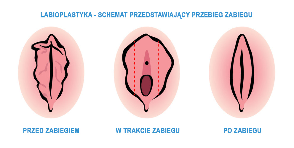 labioplastyka